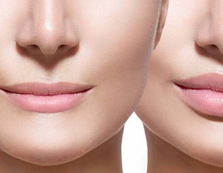 Bruise-Free <span>Facial Fillers</span> at The K Spa