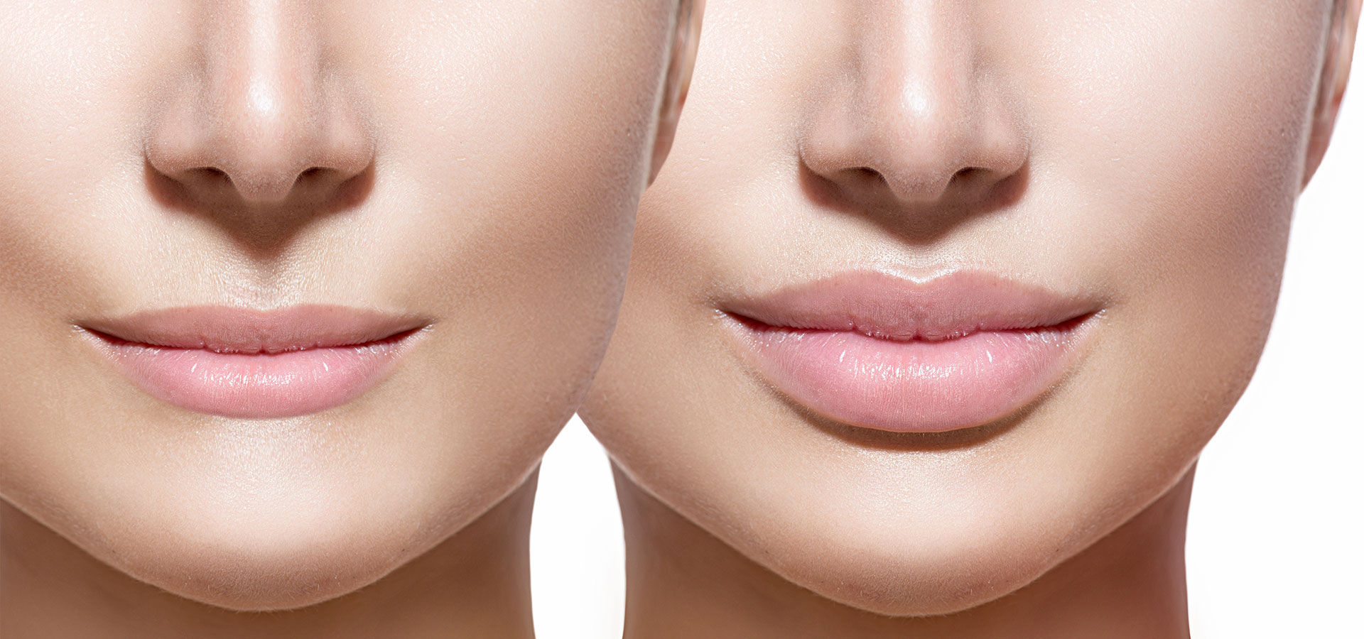 faces of two women after Lip Filler Treatment