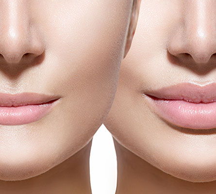 faces of two women after Lip Filler Treatment