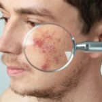 Acne Treatment Atlanta GA
